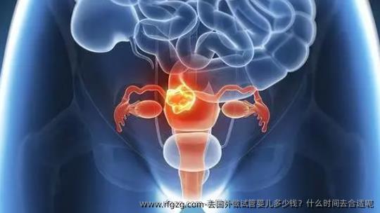 去国外做代孕多少钱？什么时间去合适呢